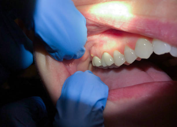 Best Emergency Tooth Extraction in Camp Hill, AL